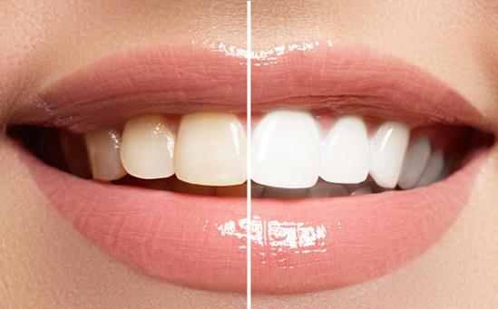 Comment utiliser des gouttières de blanchiment des dents ? - Dentifree